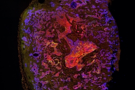 MIT researchers have found that lung tumors such as this one contain stem-cell-like cells that drive tumor aggression. In this image, those cells are tagged with a green fluorescent protein. 
