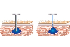 Based on research by Ian Hunter, the George N. Hatsopoulos Professor in Thermodynamics at MIT, Portal Instruments developed a jet-injection device that delivers a rapid, high-pressure stream of medicine, as thin as a strand of hair, through the skin in adjustable dosages, causing little to no pain.
