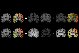 MIT researchers have developed a system that gleans far more labeled training data from unlabeled data, which could help machine-learning models better detect structural patterns in brain scans associated with neurological diseases. The system learns structural and appearance variations in unlabeled scans, and uses that information to shape and mold one labeled scan into thousands of new, distinct...