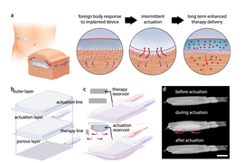 Top: a sequence of info graphics shows the location of a device implanted in a human torso, while detailed callouts show how it works under the skin, with dots representing both cells and medicine traveling to its target. Bottom: two info graphics and a photo show parts of the rectangular device, which resembles a multilayer pad connected to two small tubes.